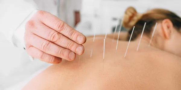 Acupuntura beneficios
