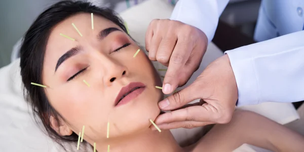 Acupuntura terapia