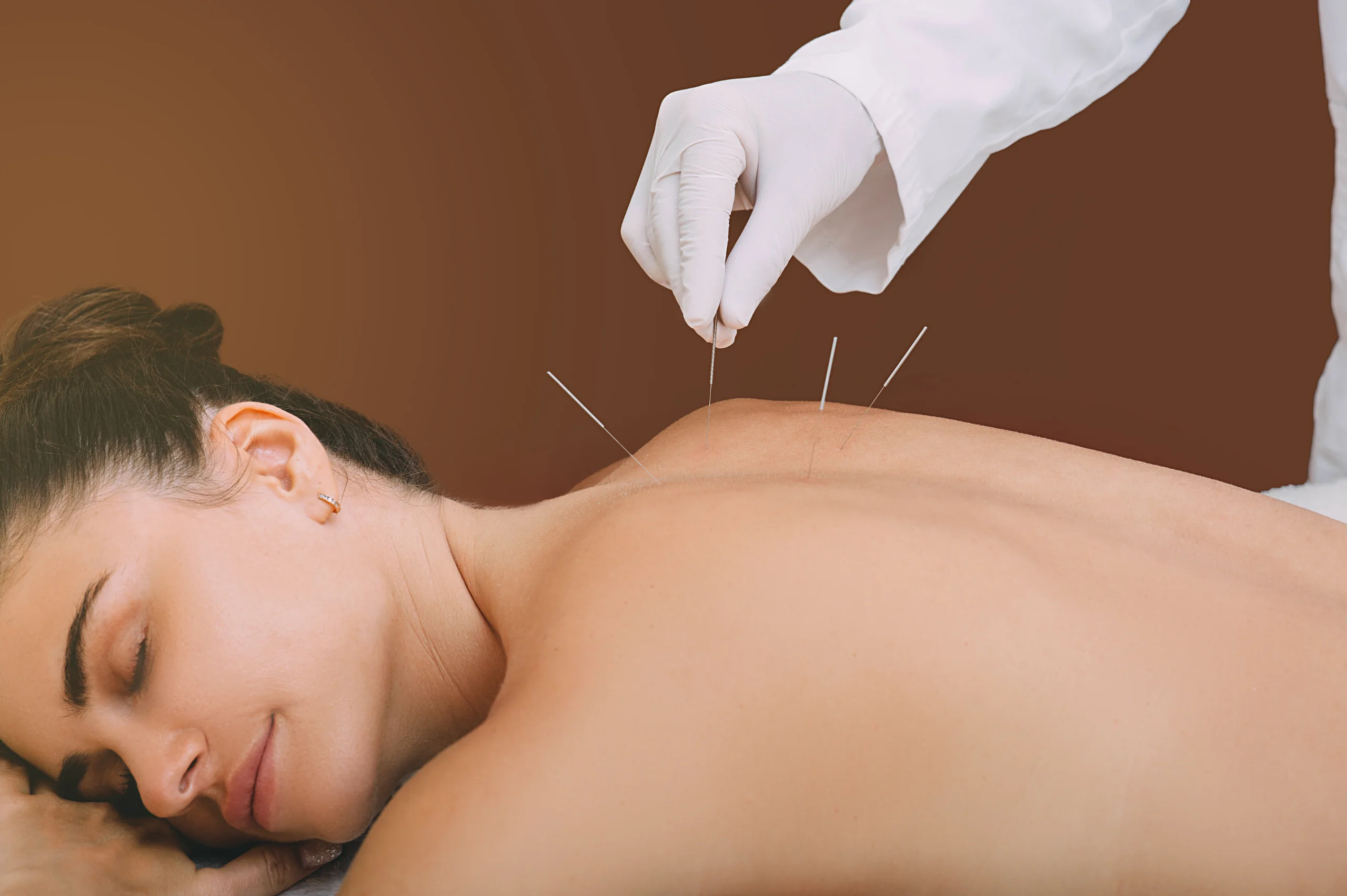 Acupuntura - 3 Acupuntura beneficios curativos